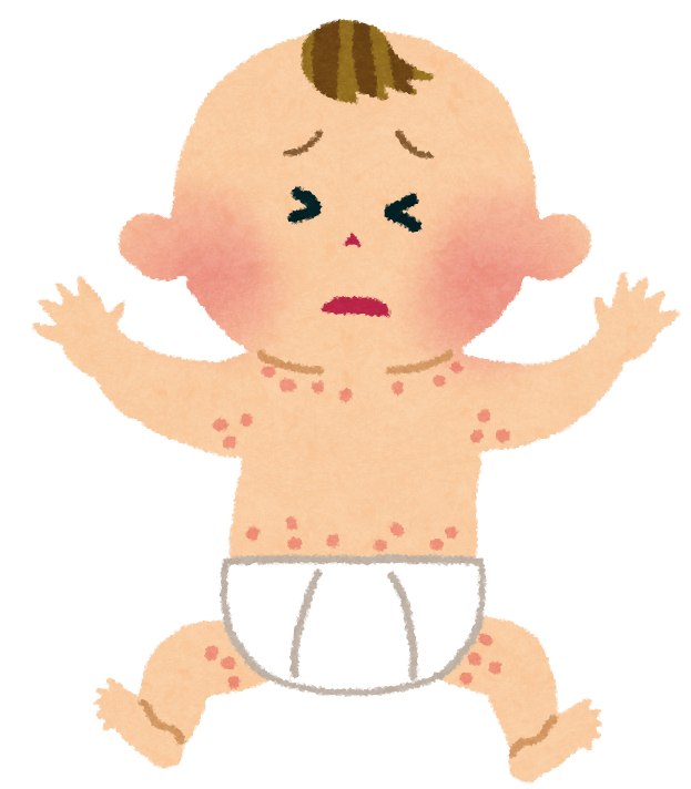 湿疹で苦しむ赤ちゃん
